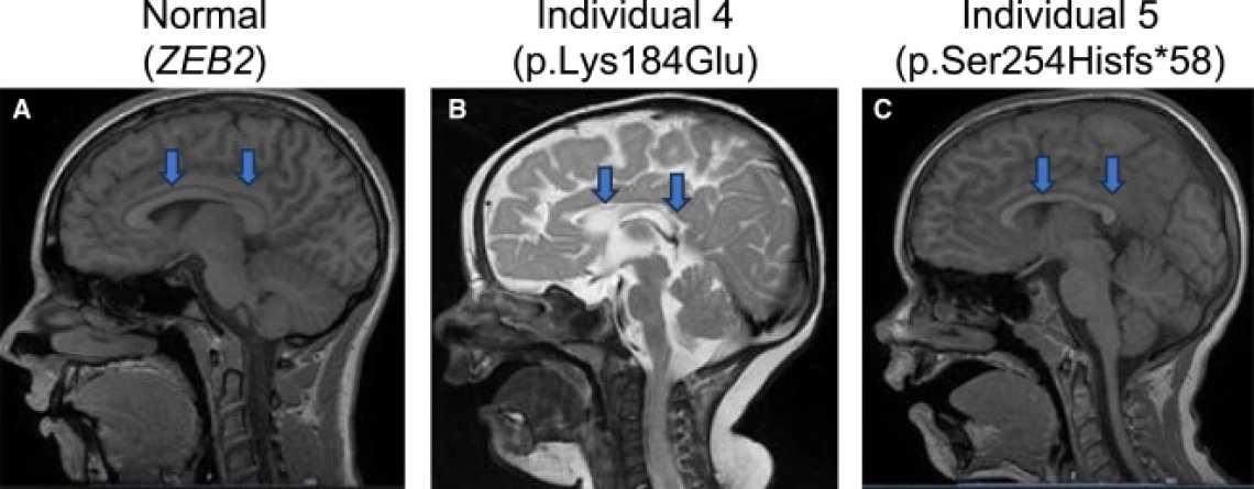 MRI Scans of 3 Individuals Displaying Variances in Regions of the Brain
